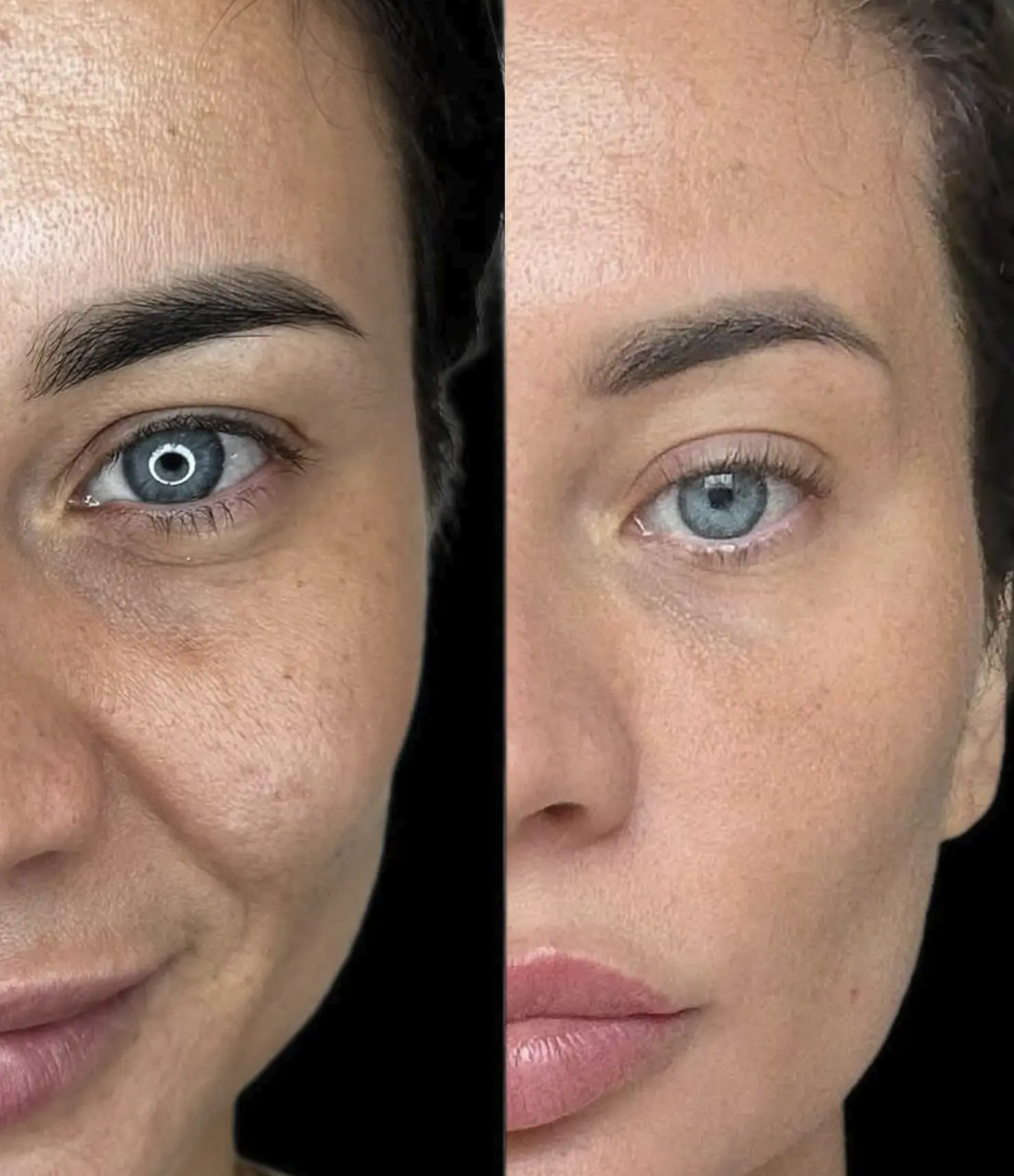 Can I Combine HydraFacial With Exosomes?