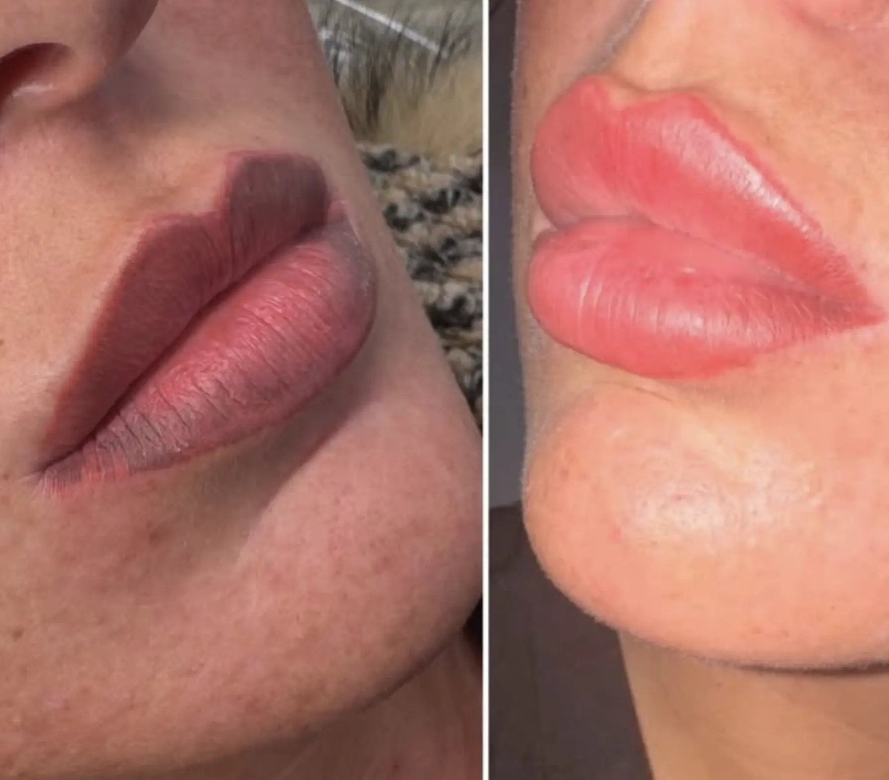 is saline tattoo removal safer than laser lips