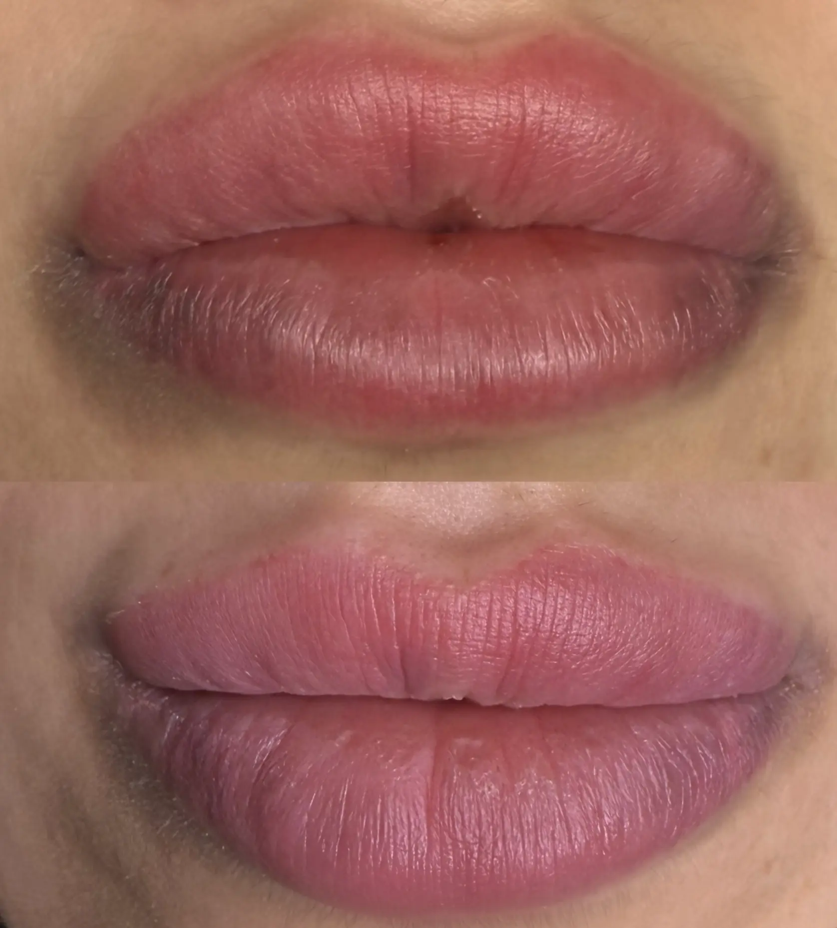 laser vs saline removal for cosmetic lip tattoo