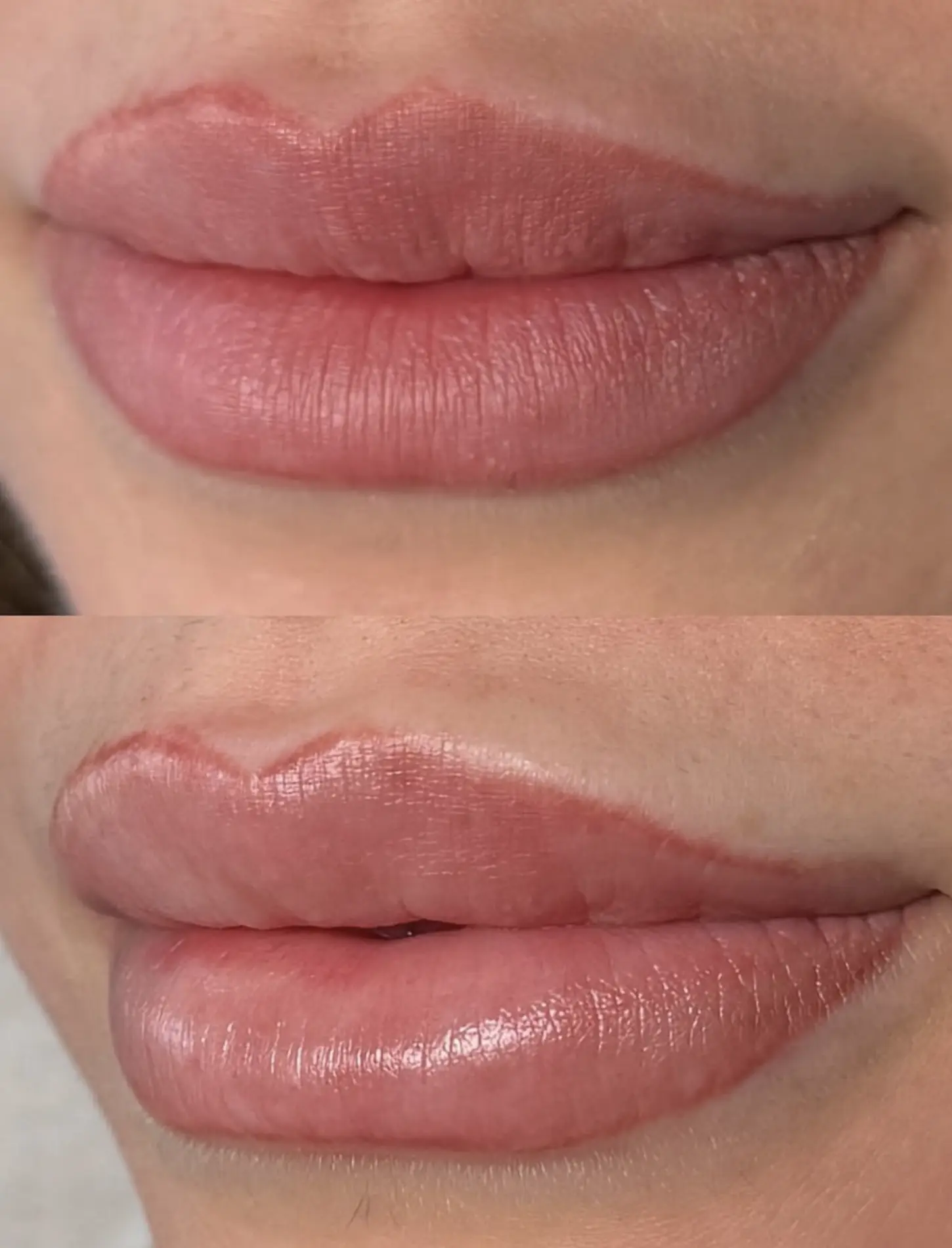 lip blush removal methods comparison 2026