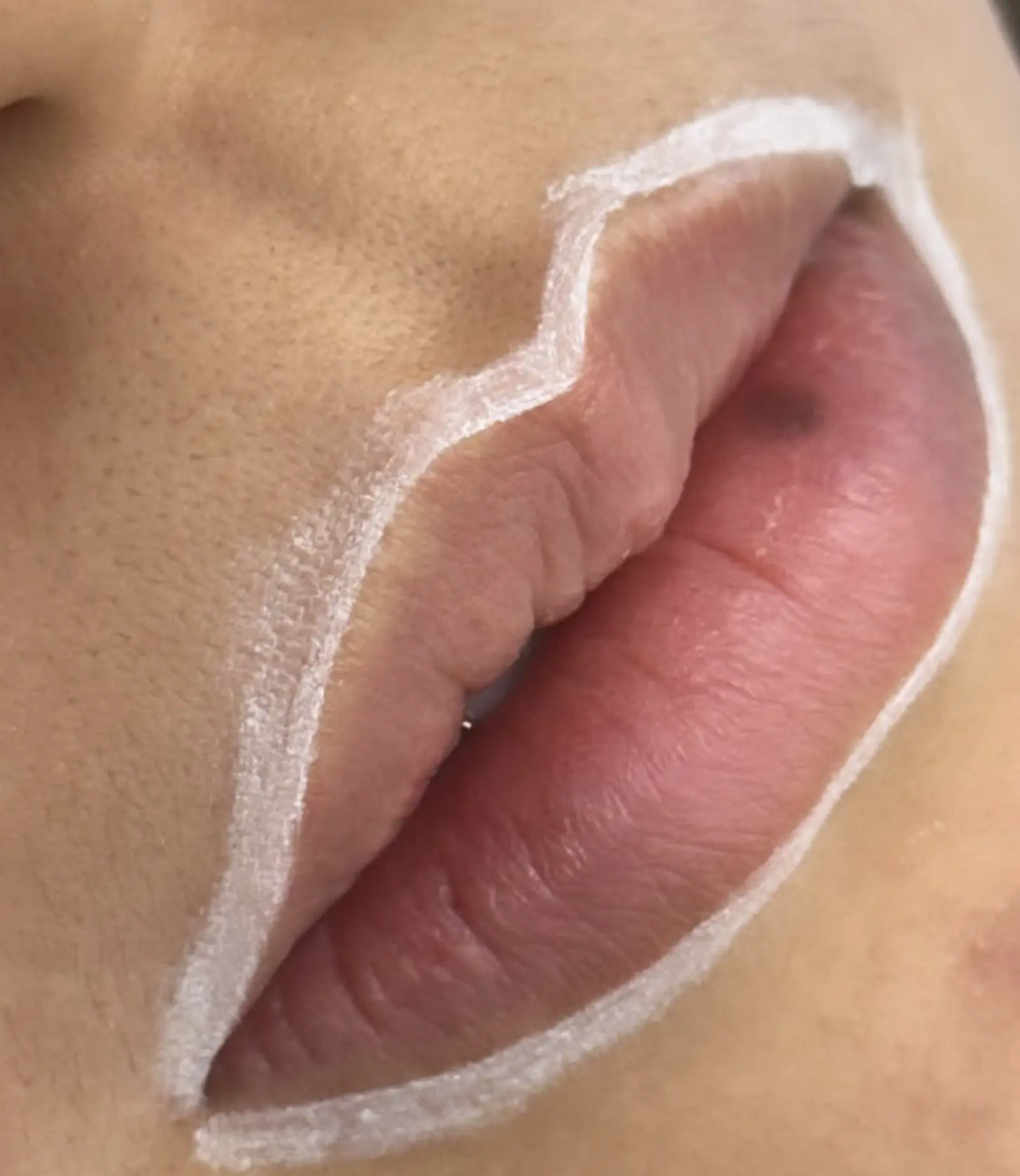 saline tattoo removal risks vs laser risks