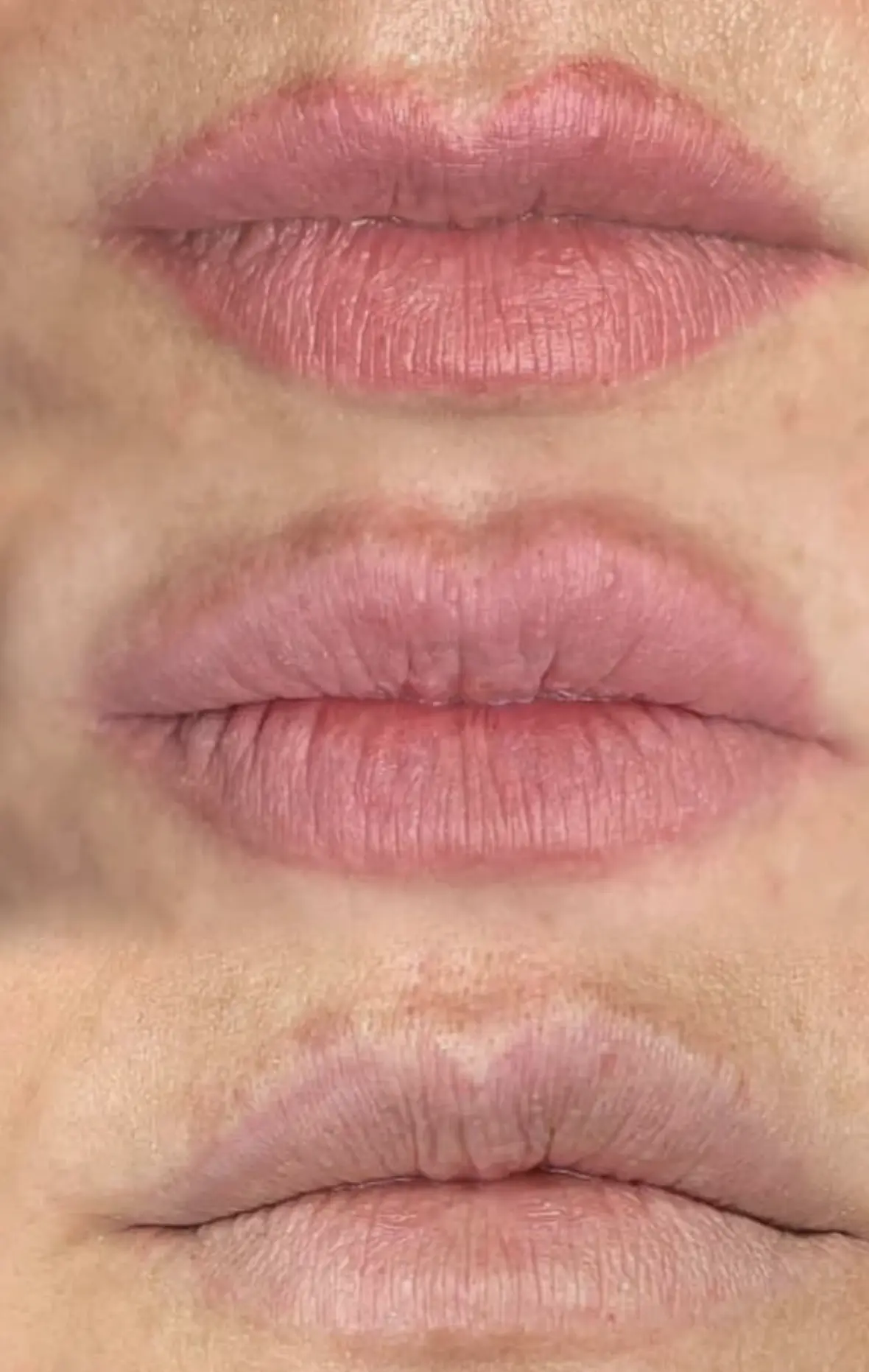 Training For ‘Salt And Saline’ Vs. Laser: Which Is Safer For Lip Blushing Removal In 2026?