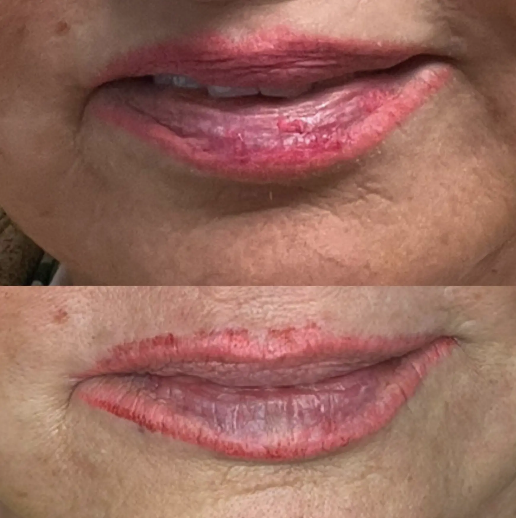 which removal method causes less scarring lips